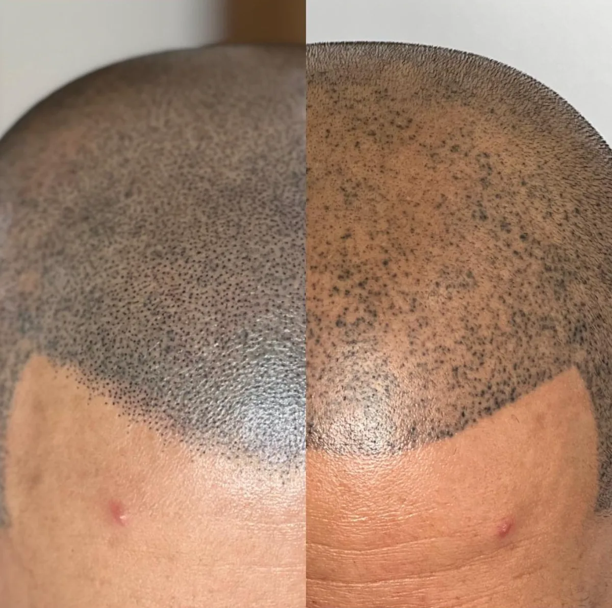 Scalp Pigmentation before and after