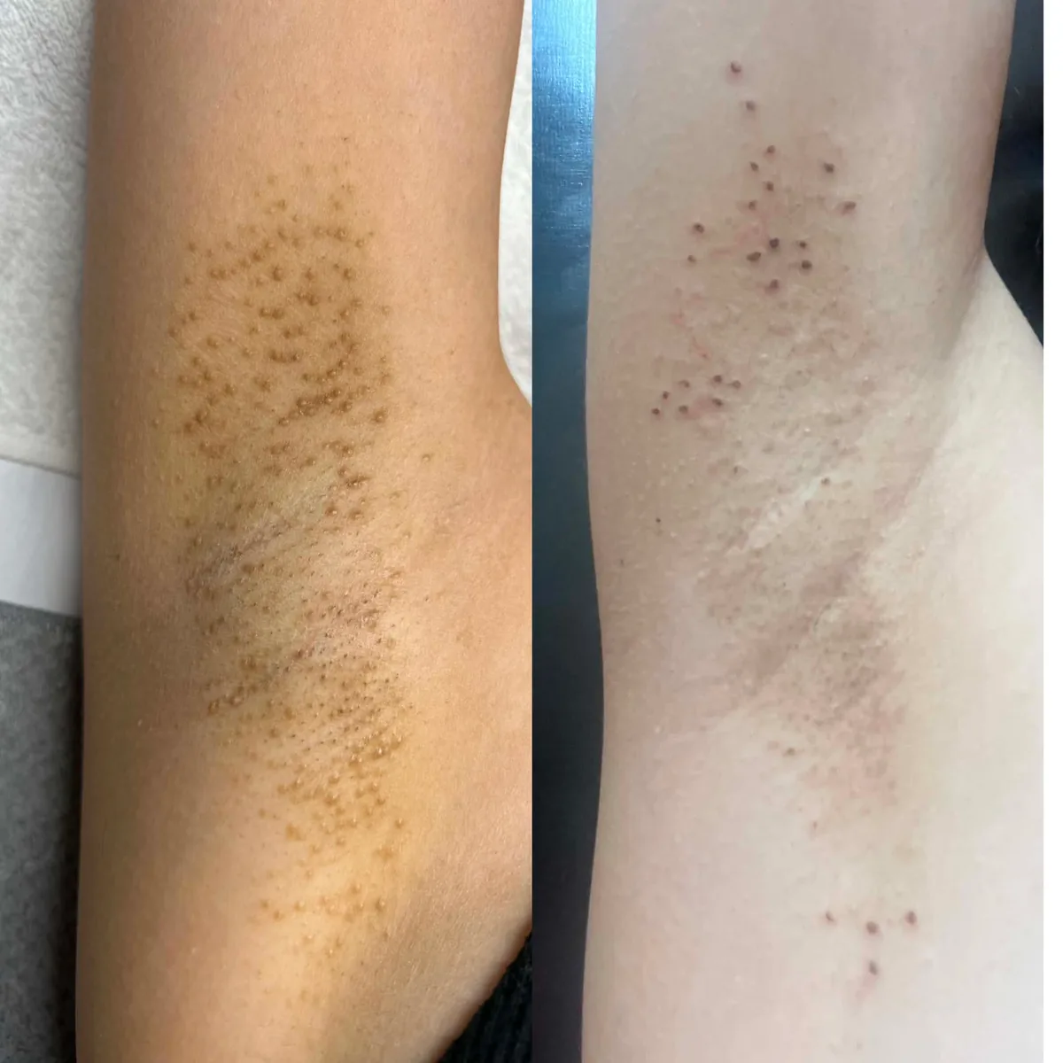 Underarm Diode Laser before and after