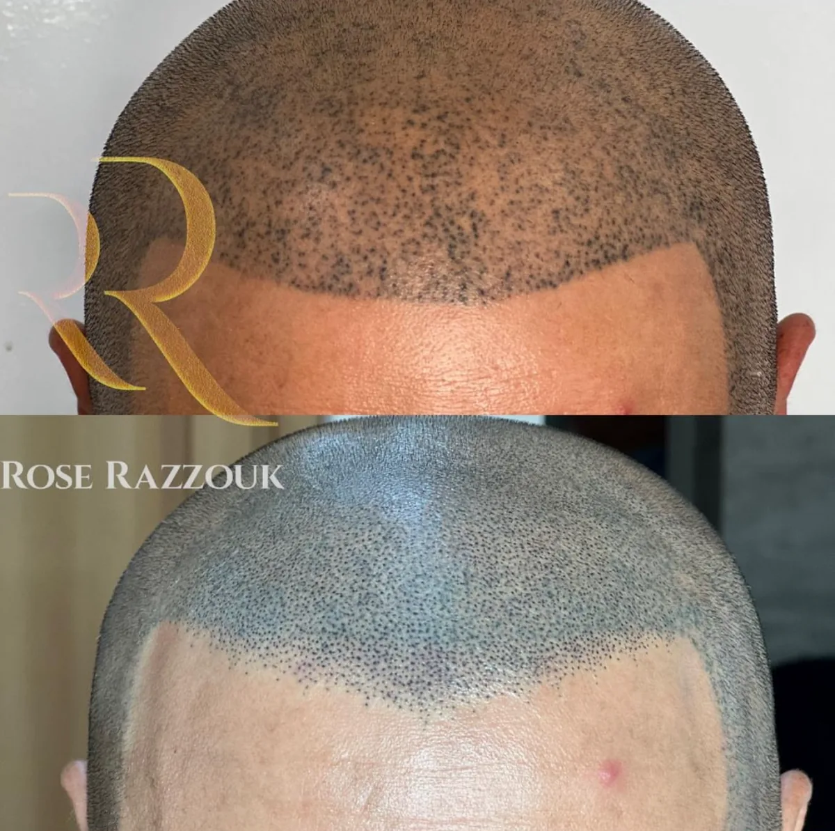 Scalp Pigmentation before and after
