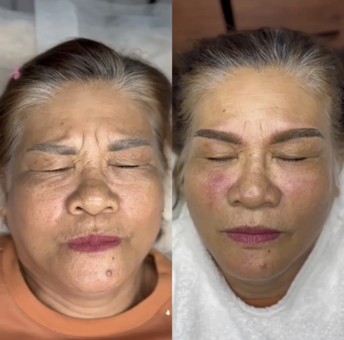 Facial Treatment before and after